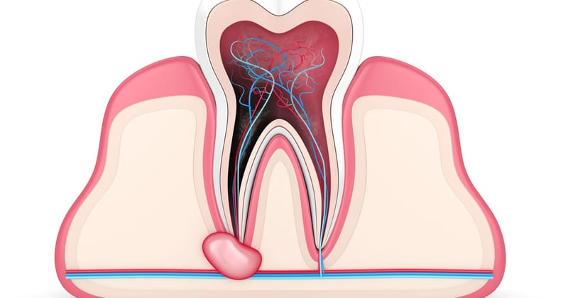 Root canal treatment diagram