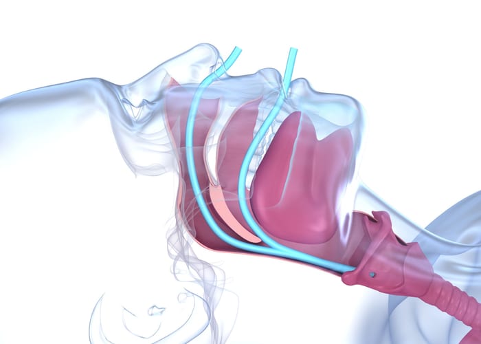 Sleep apnea treatment